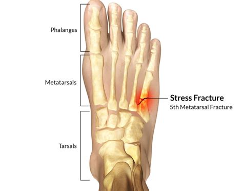 Bone Fractures Types Symptoms Treatment