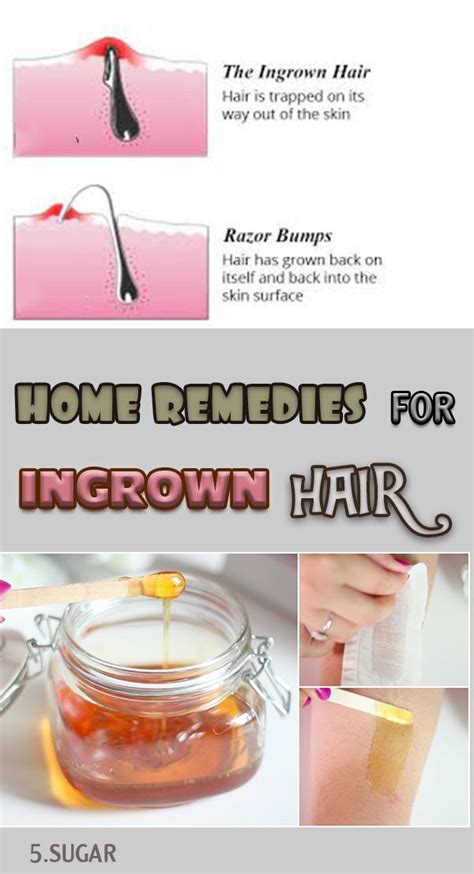 Homemade Remedies For Ingrown Hair Ingrown Hair Ingrown Hair