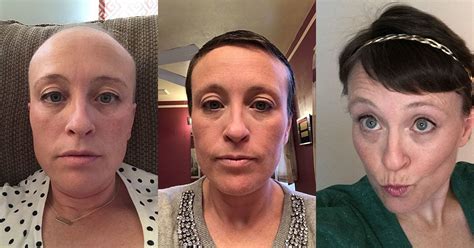 My Chemotherapy Diary 52 Photos Of Hair Loss And Recovery