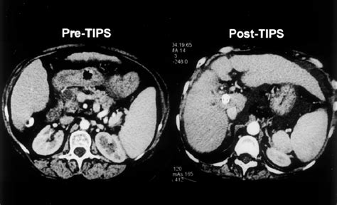 Contrast Enhanced Abdominal Computed Tomography Ct Scans Before And