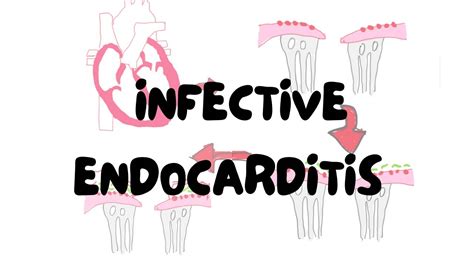 Infective Endocarditis In Under 20 Minutes Pathology Lectures By