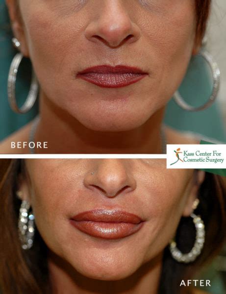 12 Lip Implants Before And After Arlenezahira