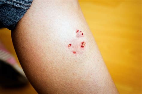 Fresh Dog Bite Puncture Marks On A Womans Leg Stock Photo Download