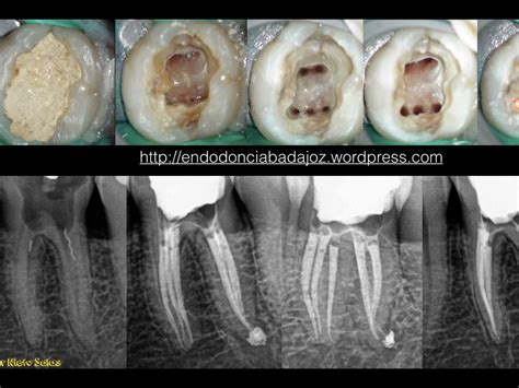 Endodoncia Accesos By Odontoblast527