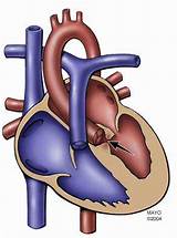 Aortic Stenosis Treatment Options