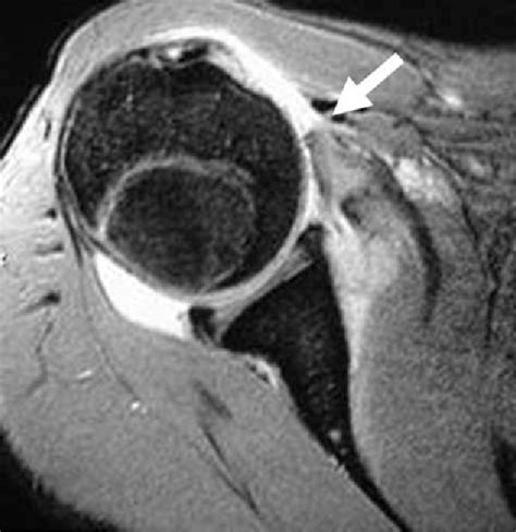 Figure 1 From Open Repair Of Isolated Traumatic Subscapularis Tendon