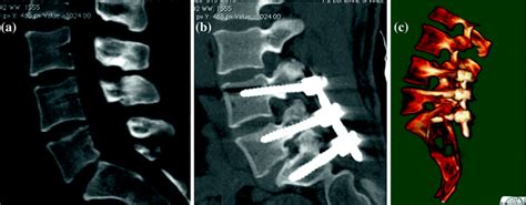 Degenerative Lumbar Instability Rigid Posterior Stabilization Radiology Key