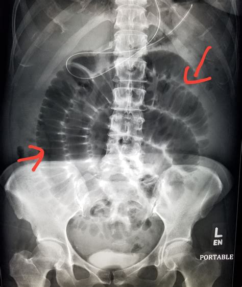 Abdomen Xray Shows Dilated Small Bowel From Obstruction Sbo Radiology Radiologist
