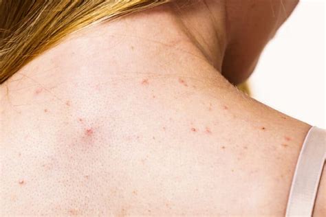 What Is Fungal Acne A Derm Explains What It Looks Like And How To Treat