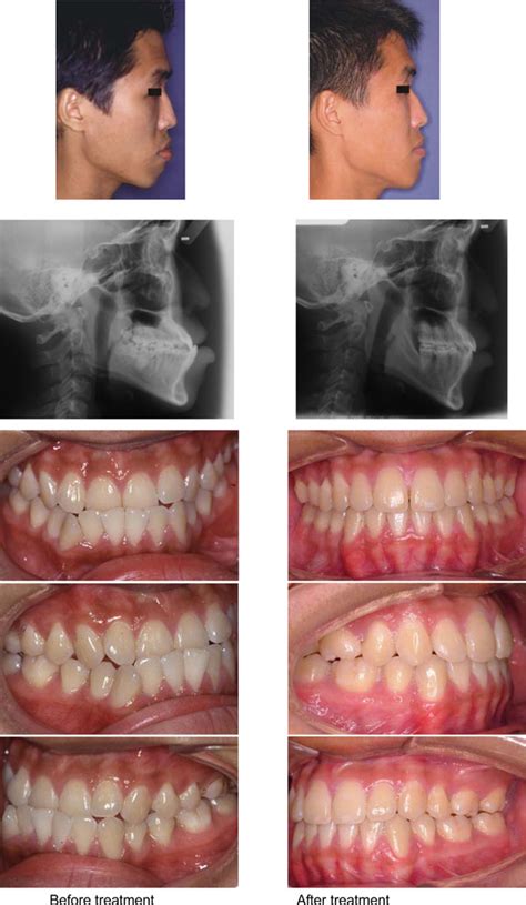 Treatment In Borderline Class Iii Malocclusion Orthodontic Camouflage