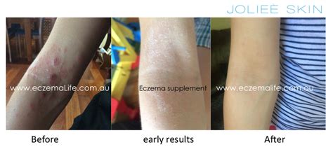 Eczema Treatments Before And After Eczema Life