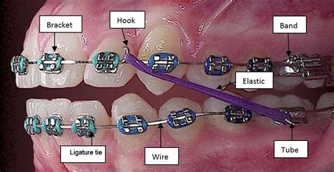 Do You Know The Parts Of Your Braces And Why Its Important