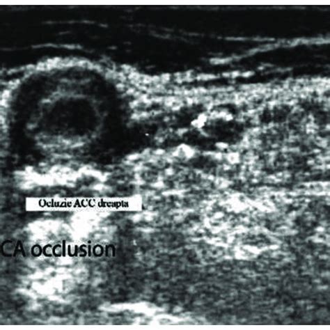 Duplex Ultrasound Of The Right Temporal Artery−transverse View The
