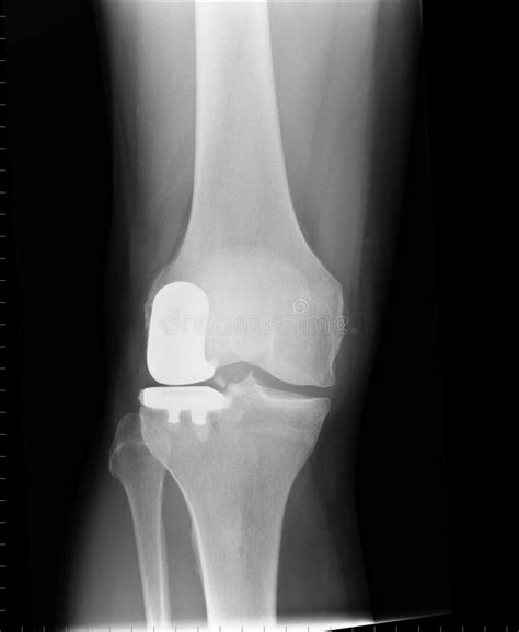 X Ray Of A Unilateral Knee Replacement Stock Image Image 15680829