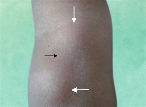 Anterior Elbow Swelling Of Lipoma Arboresens That Causes Elbow Pain