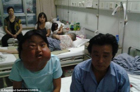 Li Hongfang Woman Disfigured By Facial Tumours Will Make A Full