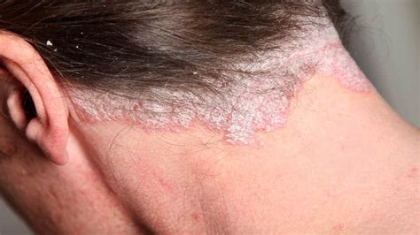 Aprender Sobre Imagem Eczema Couro Cabeludo Fotos Br Thptnganamst Edu Vn