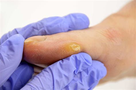Corns And Callus Treatment In Farnham Surey Foot Hard Skin Removal