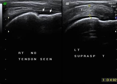 High Resolution Sonography In Rotator Cuff Tear Sumer S Radiology Blog