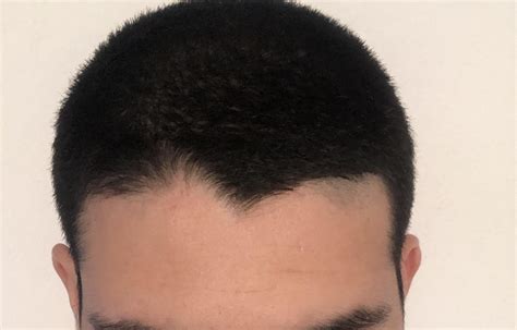 I Have This Weird Looking Hairline And I Don’t Know What To Do About It Any Advice R