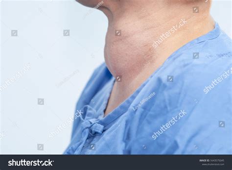 Enlarged Multinodular Thyroid Goiter Middleaged Asian ภาพสต็อก