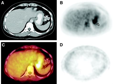 To Enhance Or Not To Enhance 18f Fdg And Ct Contrast Agents In Dual