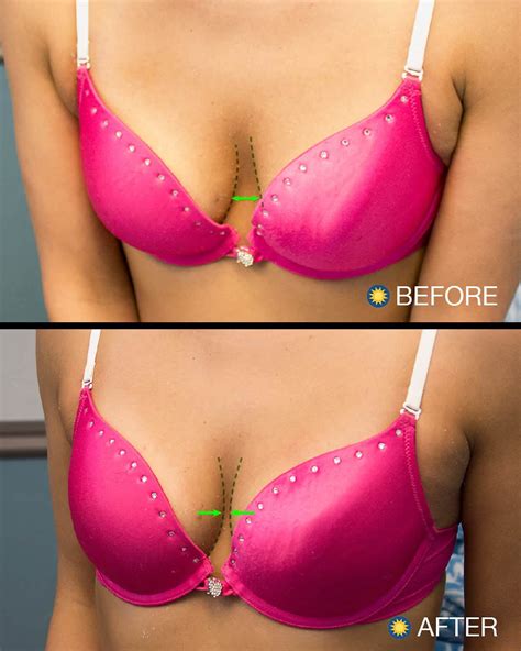 Prp Juvederm® Breastlift And Breast Enhancement Peoria Az
