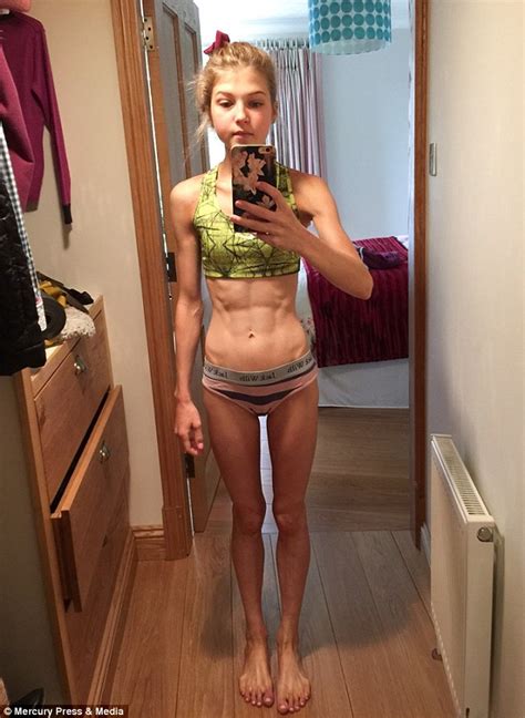 Anorexic Whose Weight Plummeted To Five Stone Turned Life Around To