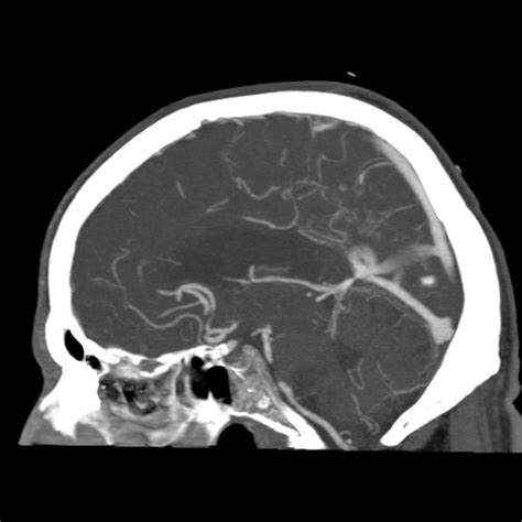 Clinical Cases Brain And Head And Neck Male 89 Years Old Comatose