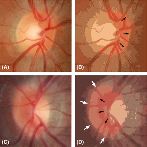Differentiation Between Optic Disc Drusen And Optic Disc Oedema Using