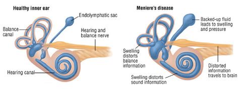 Menieres Disease Vertigo Tinnitus Hearing Loss Bowen Therapy