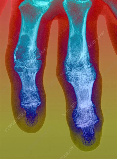 Arthritic Fingers X Ray Stock Image C0226829 Science Photo Library