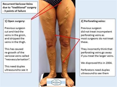 Recurrent Varicose Veins Due To Traditional Surgery The