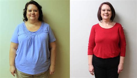 Gastric Sleeve Before And After What To Expect Rgastritis