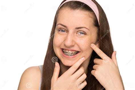 Smiling Girl With Braces Squeezing Pimple Isolated Stock Image Image