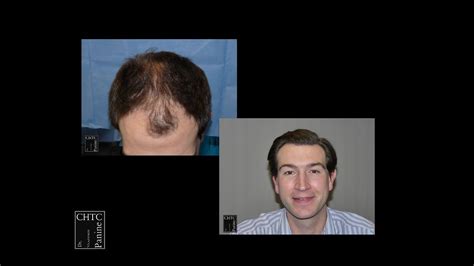 Panine Md Chicago Hair Transplant Clinic Hair Restoration Patient