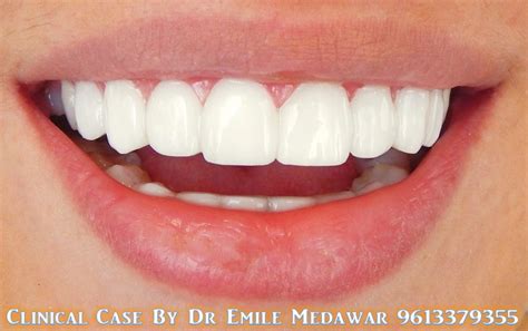 Hollywood Smile Veneers Dental Implant In Lebanon Style Dental Clinic