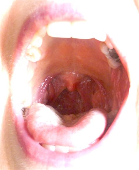 Swelling Parotid Gland And Sore Throat
