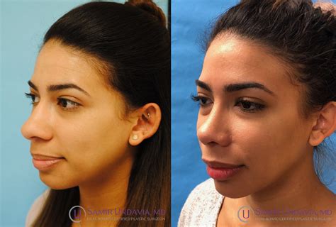This Is A 6 Month Before And After Rhinoplasty And Alar Base Reduction