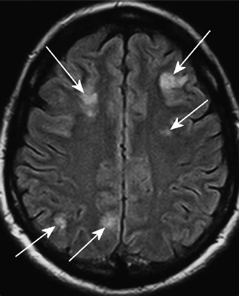 Fig 1 Initial Flair Mri Images Through Frontal And Parietal Lobes
