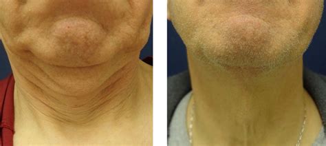 Lower Facelift And Neck Lift Neck Lift Surgery Service Chicago