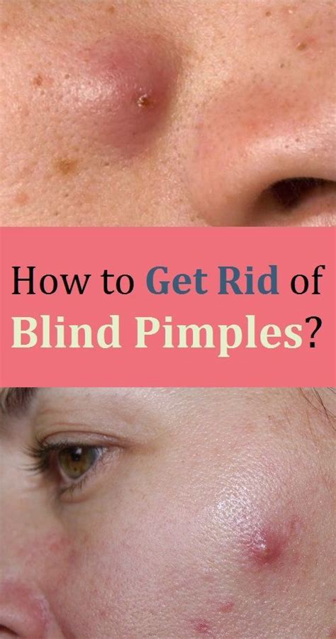 How To Get Rid Of Blind Pimples Blind Pimple Cystic Acne Treatment