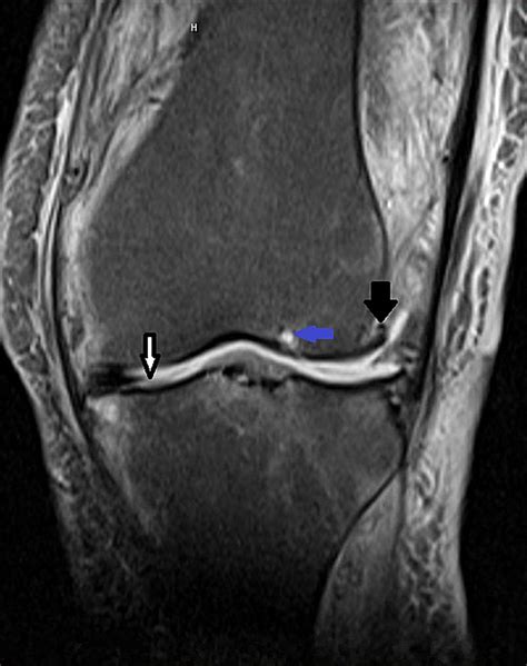 Cureus A Rare Case Of Septic Knee Arthritis Caused By Clostridium