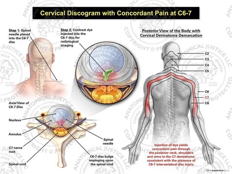 Male Central Cervical Discogram With Concordant Pain At C6 7