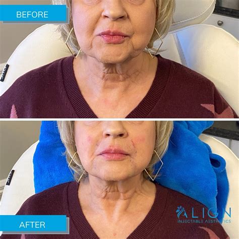 Before And After Treatment For Marionette Lines Align Injectable