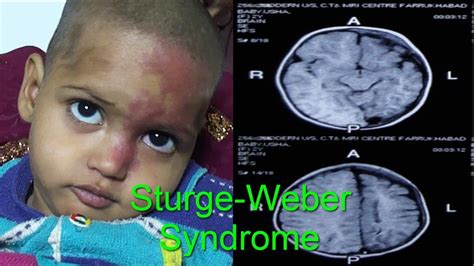 Sturge Weber Syndrome