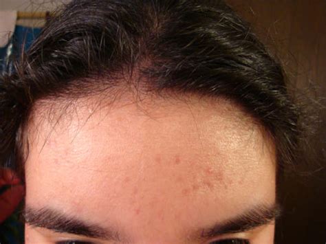 Member Pictures Clogged Pores And Inflamed Acne Forehead 020809