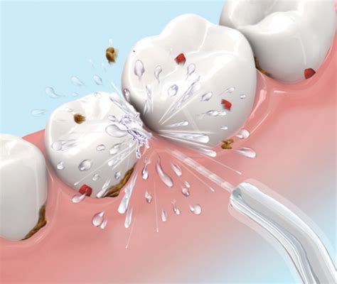 Interdental Cleaning Dental Floss Vs Water Pick Vs Interdental