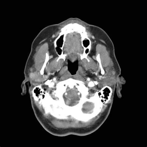 Adenoid Cystic Carcinoma Of The Parotid Gland Radiology Case