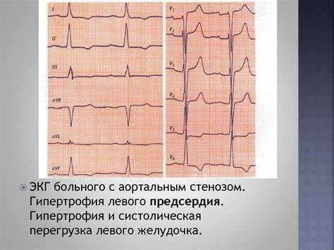 Диета при стенозе устья аорты Аортальный стеноз - презентация онлайн Аортальный стеноз - презентация онлайн Диета при стенозе устья аорты
